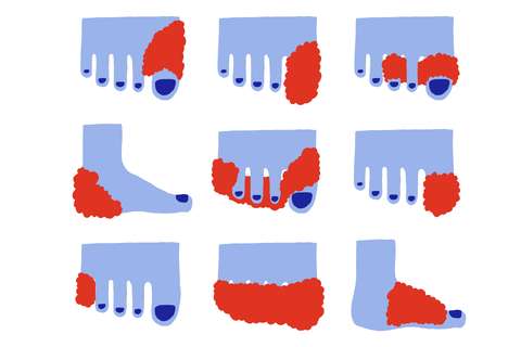 Hoe brengt u loperswol aan | ANBO-PCOB